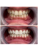 エクシアホワイトニング 日本橋店/ブライダルホワイトニング