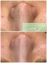 エヌエースキン 北谷店(NAskin) NA skin 毛穴ケア