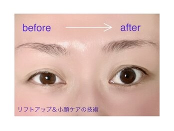 リリーマリア(Lily Maria)/殿堂人気☆小顔ケアbefore/after