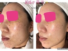 ウカ(uka)/シミケアにお客様♪