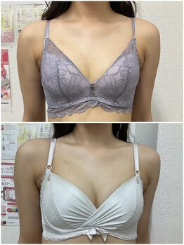 バーディー(BIRDIE)/施術９カ月/２０代/AA→Cカップ