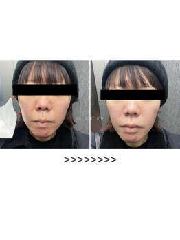 カランコエ(KALANCHOE)/ハーブピーリングでデトックス！