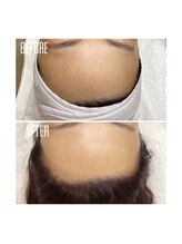 ホワイトワックス 京都四条烏丸(WHITE WAX)/おでこのくすみ解消！！