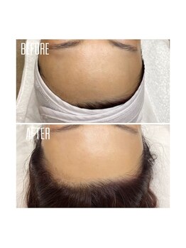 ホワイトワックス 京都四条烏丸(WHITE WAX)/おでこのくすみ解消!!