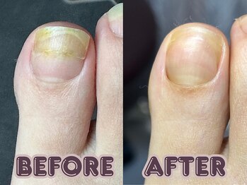 ポドロ ウィズ ニコルル 大阪天満店(PoDoLo with Nicolulu)/【二枚爪】フットケア大阪・梅田