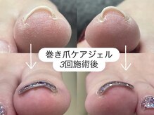 リ ボディ 札幌駅前店(Re Body)/巻き爪ケアジェル　7700円