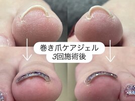 巻き爪ケアジェル　7700円