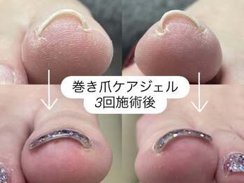 巻き爪ケアジェル　7700円