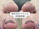 巻き爪ケアジェル　7700円