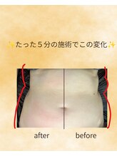 ココ ビューティ(COCO Beauty)/痩身ビフォーアフター
