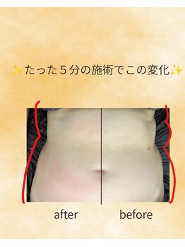 ココ ビューティ(COCO Beauty)/痩身ビフォーアフター