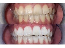 ホワイトニングビューティー 光の森店(WHITENING BEAUTY)の雰囲気(ホワイトニング専門店ならではの圧倒的な白さ♪飲食制限なし♪)