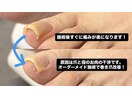 巻き爪は爪との干渉が原因?