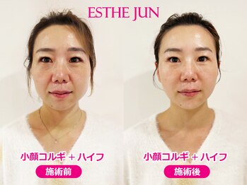 エステジュン(ESTHE JUN)/