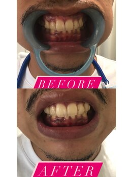 ヴァーチュ(Virtue)/ホワイトニング