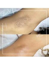 テンポフェリーチェ 浜松店(Tempo Felice)/浜松脱毛/都度払い/メンズ脱毛