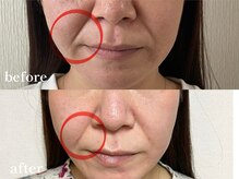 エピリス(Epiliss)/ほうれい線ビフォーアフター