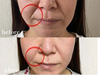 エピリス(Epiliss)/ほうれい線ビフォーアフター