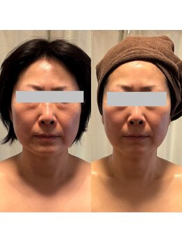 ニコ(NIKO)/【最新機器グロッティプロ】