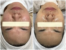 オージャス(OJAS)/50代の方　小顔フェイシャル