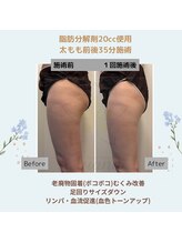 ルアナ(Luana)/脂肪分解＆燃焼！引き締めケア