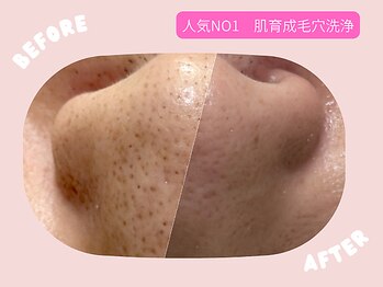 Wax脱毛&毛穴専門店　D-lotusの写真/肌に優しい温泉水で毛穴洗浄！傷めず浮かせて黒ずみ除去を目指す☆TENNYOコンテストMVP受賞サロン♪