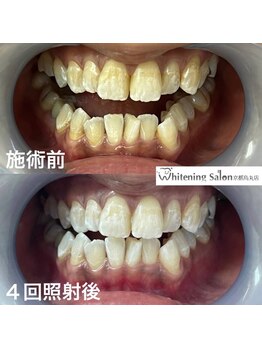 ホワイトニングサロン 京都烏丸店/ホワイトニング施術例