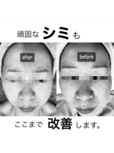 エメ(Aimer)/フェイシャル