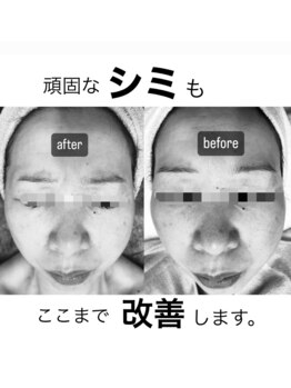 エメ(Aimer)/フェイシャル