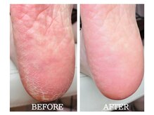 ウォーク イオンスタイル東淀川(WALK)/【カカト角質】フットケア大阪