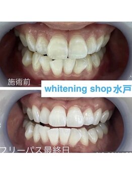 ホワイトニングショップ 水戸駅前店/#水戸ホワイトニング#水戸エステ
