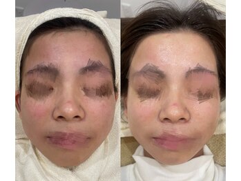 スターラッシュ(Star Lash)/Wax&美肌脱毛1回施術前後