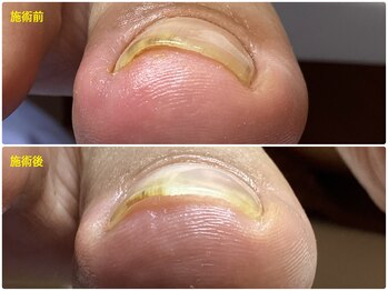 フットケアリストシュウ(footcarelist shu)/施術【巻き爪】最新ジェルケア