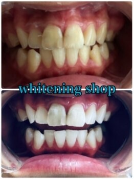 ホワイトニングショップ 池袋店/歯科医師提携積ホワイトニング