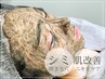 ニキビケア・肌質改善【高品質ハーブピーリング】※ハード系だからこそ効果◎