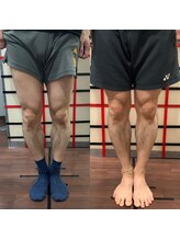 目黒もりおか整骨院/Ｏ脚矯正ビフォーアフター