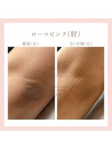 ヨウン 大阪心斎橋(yeoun)/ローマピンク大阪/メラニンケア