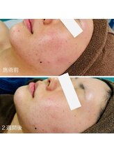 カピリナ(kapilina)/剥離なし２週間の変化です！