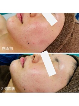 カピリナ(kapilina)/剥離なし２週間の変化です！