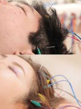 鍼灸施術を受けたい