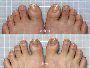 ニーヨンゼロ(240)/巻き爪・タコ・ウオノメ再発予防