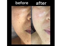 シュバル(CHEVAL)/人気BBLフェイシャル