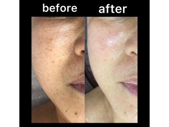 シュバル(CHEVAL)/人気BBLフェイシャル