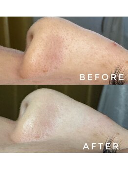 カウニス るる(kaunis)/【ララピール】Before After