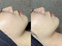 エモーショナル 姫路(Emotional)/ララピール×LDM【毛穴/艶肌】