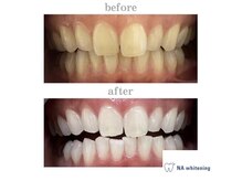 エヌエーホワイトニング たまプラーザ店(NAホワイトニング)/ビフォーアフター