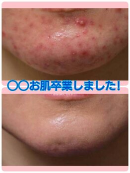 キッカ 梅田天六(Kikka)/しつこい顔周り、あごニキビに☆