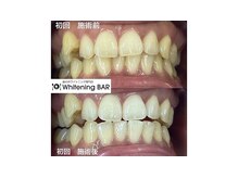 ホワイトニングバー 心斎橋オーパ店/初回の2回照射で笑顔が変わる！