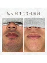 ボゴス 天白店(BOGOSS)/【ヒゲ脱毛】施術写真