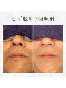 ボゴス(BOGOSS)/ヒゲ脱毛7回照射